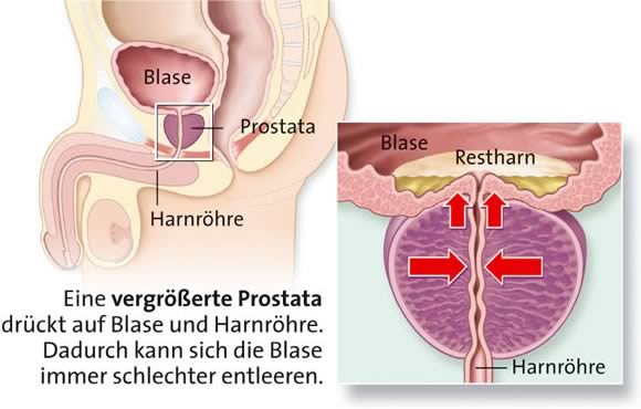 Viagra wirkung nach prostata-op